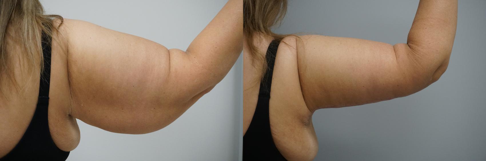 Before & After Brachioplasty Case 98 View #3 View in Gilbert, AZ
