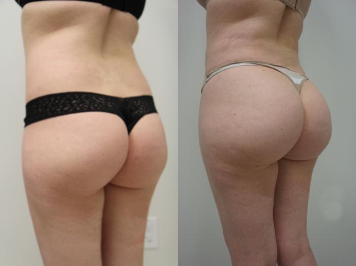 Before & After Brazilian Buttock Lift Case 107 View #1 View in Gilbert, AZ