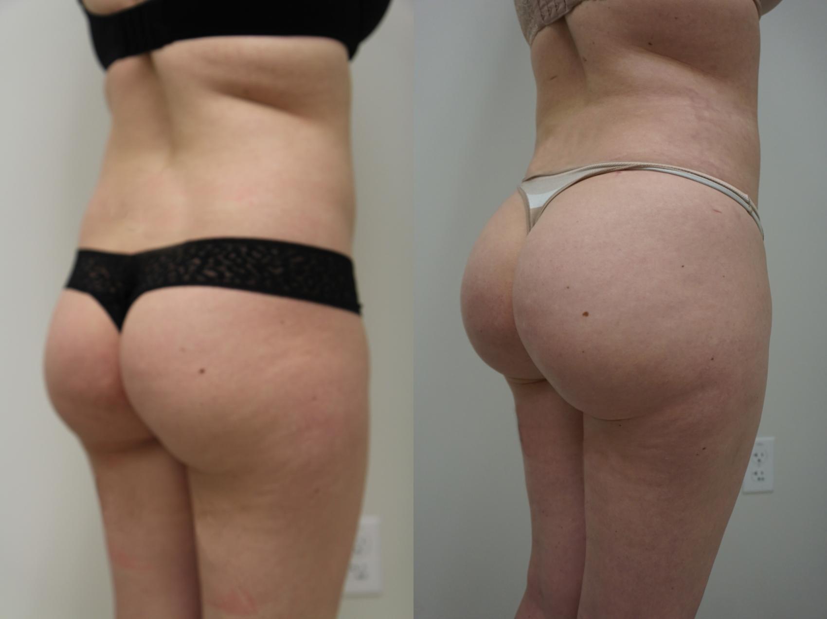 Before & After Brazilian Buttock Lift Case 107 View #2 View in Gilbert, AZ