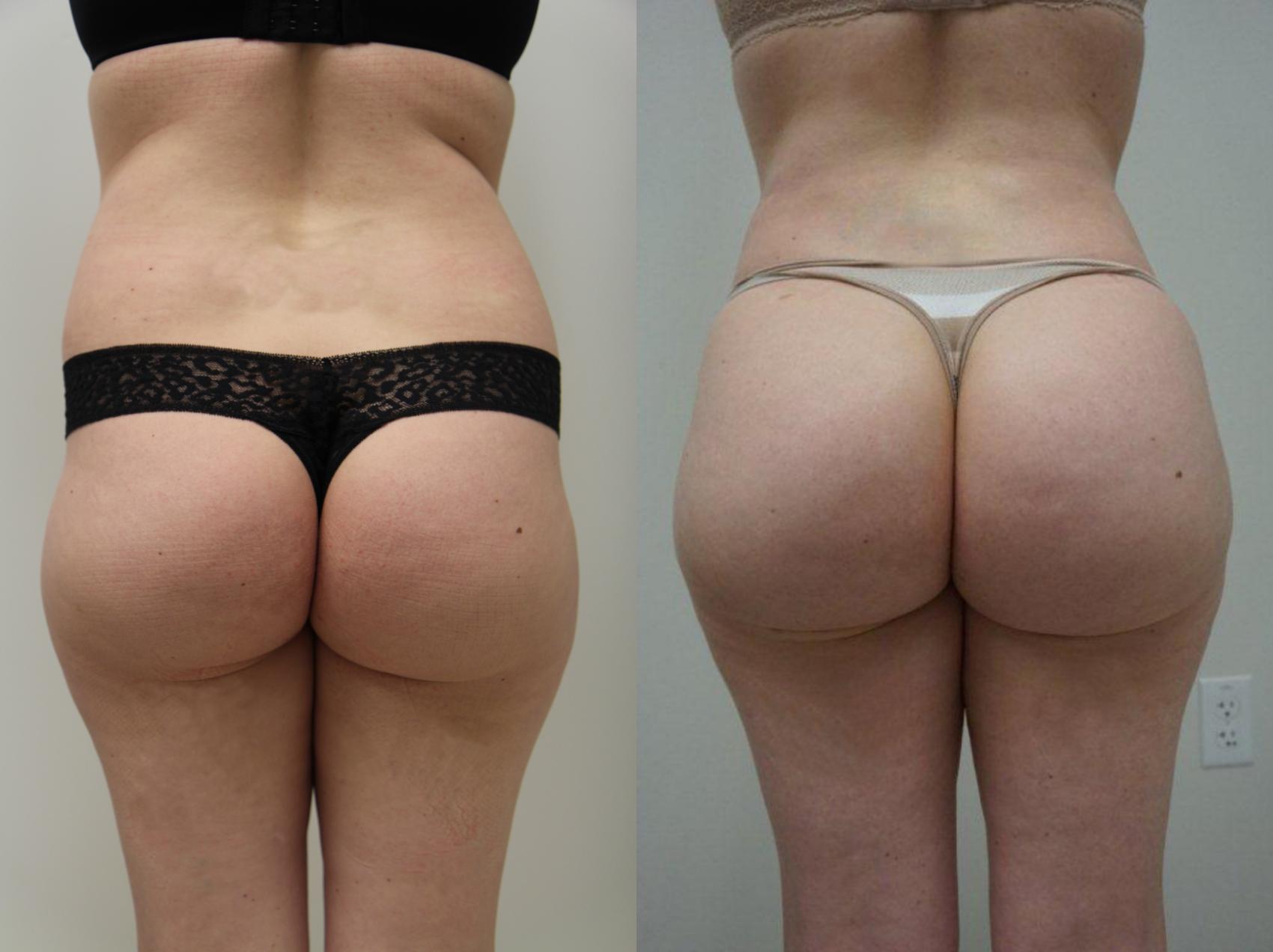 Before & After Brazilian Buttock Lift Case 107 View #3 View in Gilbert, AZ