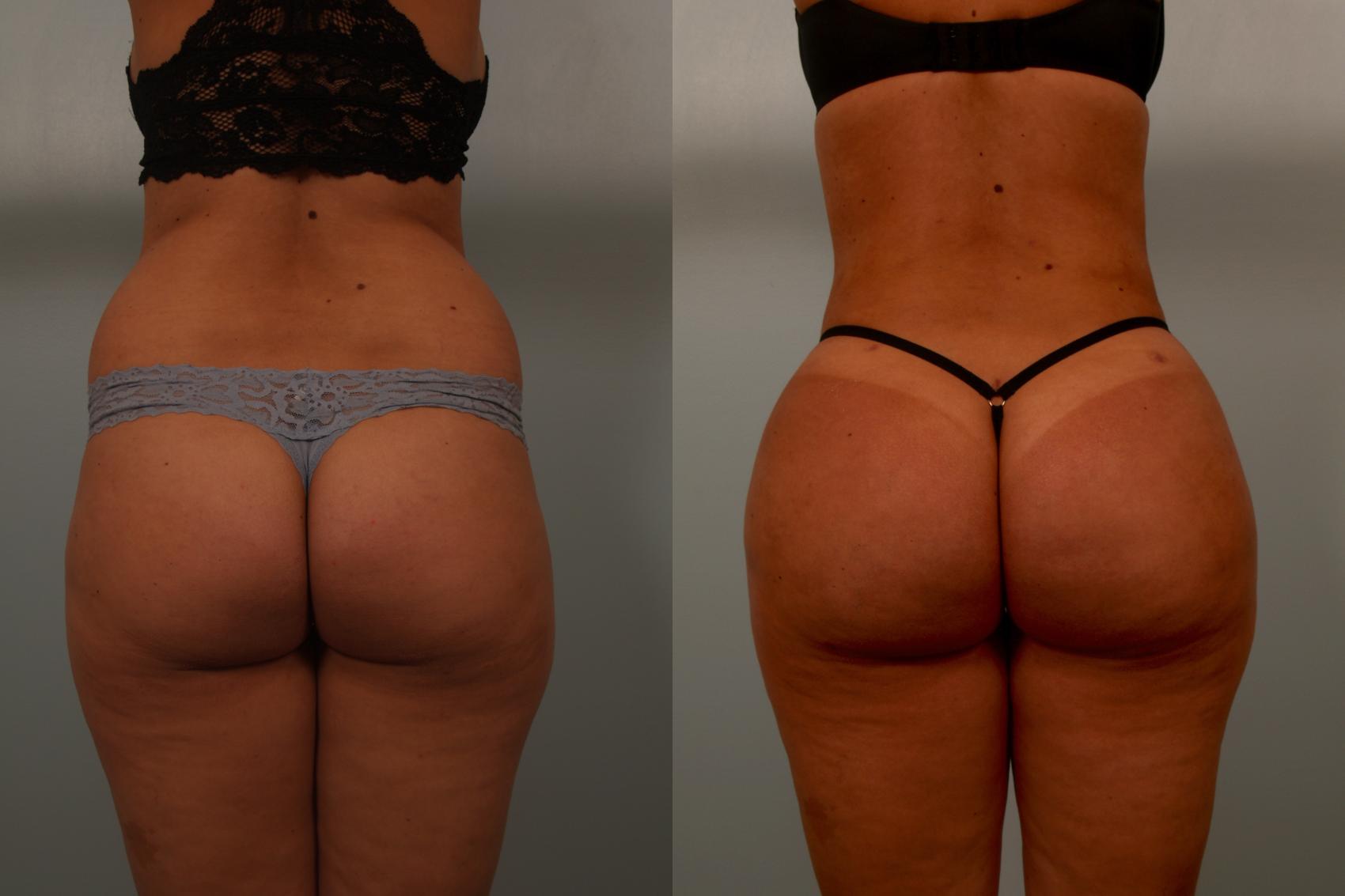 Brazilian Butt Lift for Chandler & Scottsdale, AZ