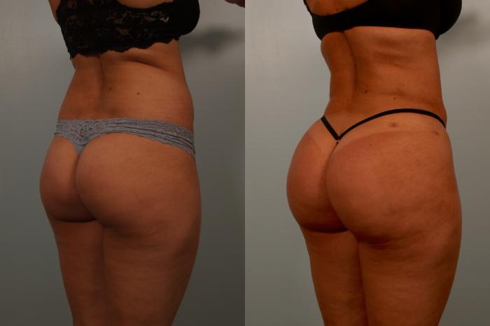 Before & After Brazilian Buttock Lift Case 119 View #2 View in Gilbert, AZ
