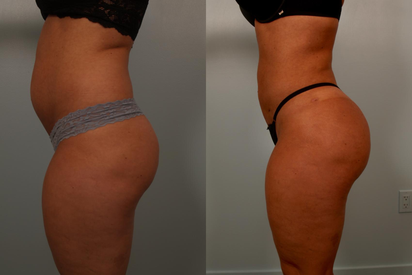Before & After Brazilian Buttock Lift Case 119 View #3 View in Gilbert, AZ