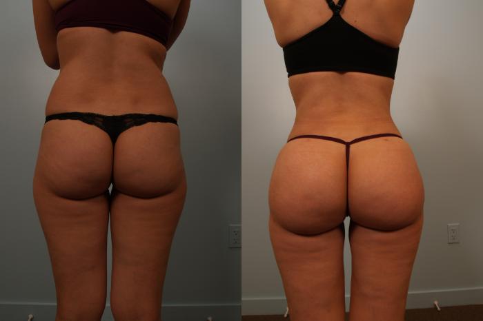 Before & After Brazilian Buttock Lift Case 131 View #1 View in Gilbert, AZ
