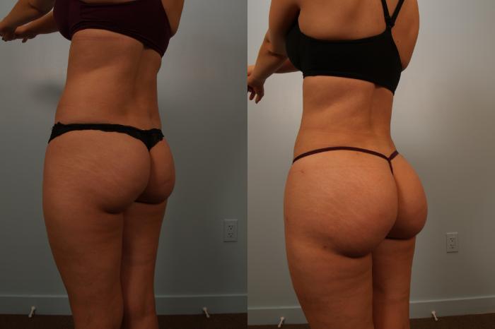 Before & After Brazilian Buttock Lift Case 131 View #2 View in Gilbert, AZ