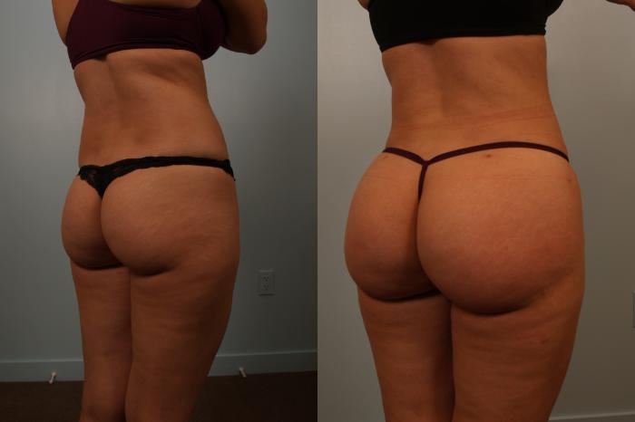 Before & After Brazilian Buttock Lift Case 131 View #3 View in Gilbert, AZ