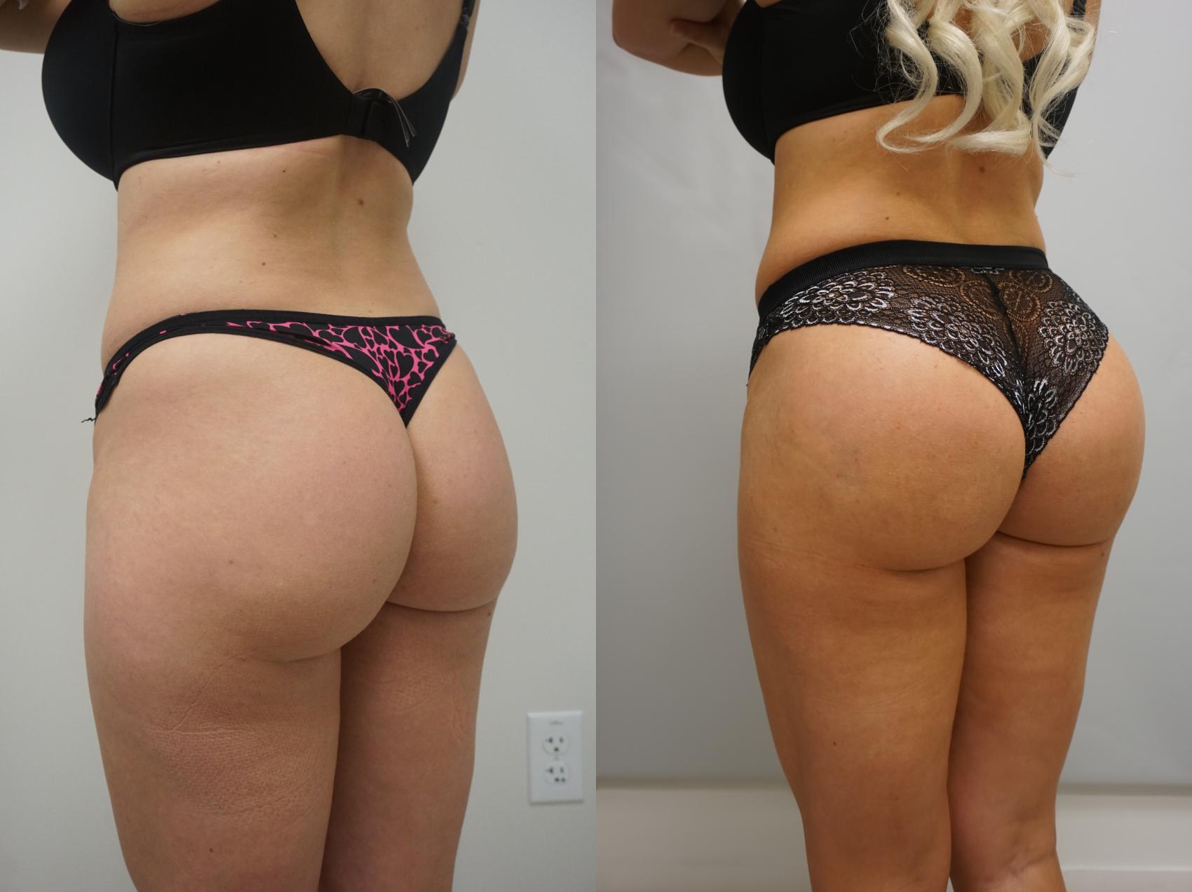 Buttock augmentation, sometimes referred to as a BBL or Brazilian Butt Lift  using your own fat or implants, can surgically increase the s