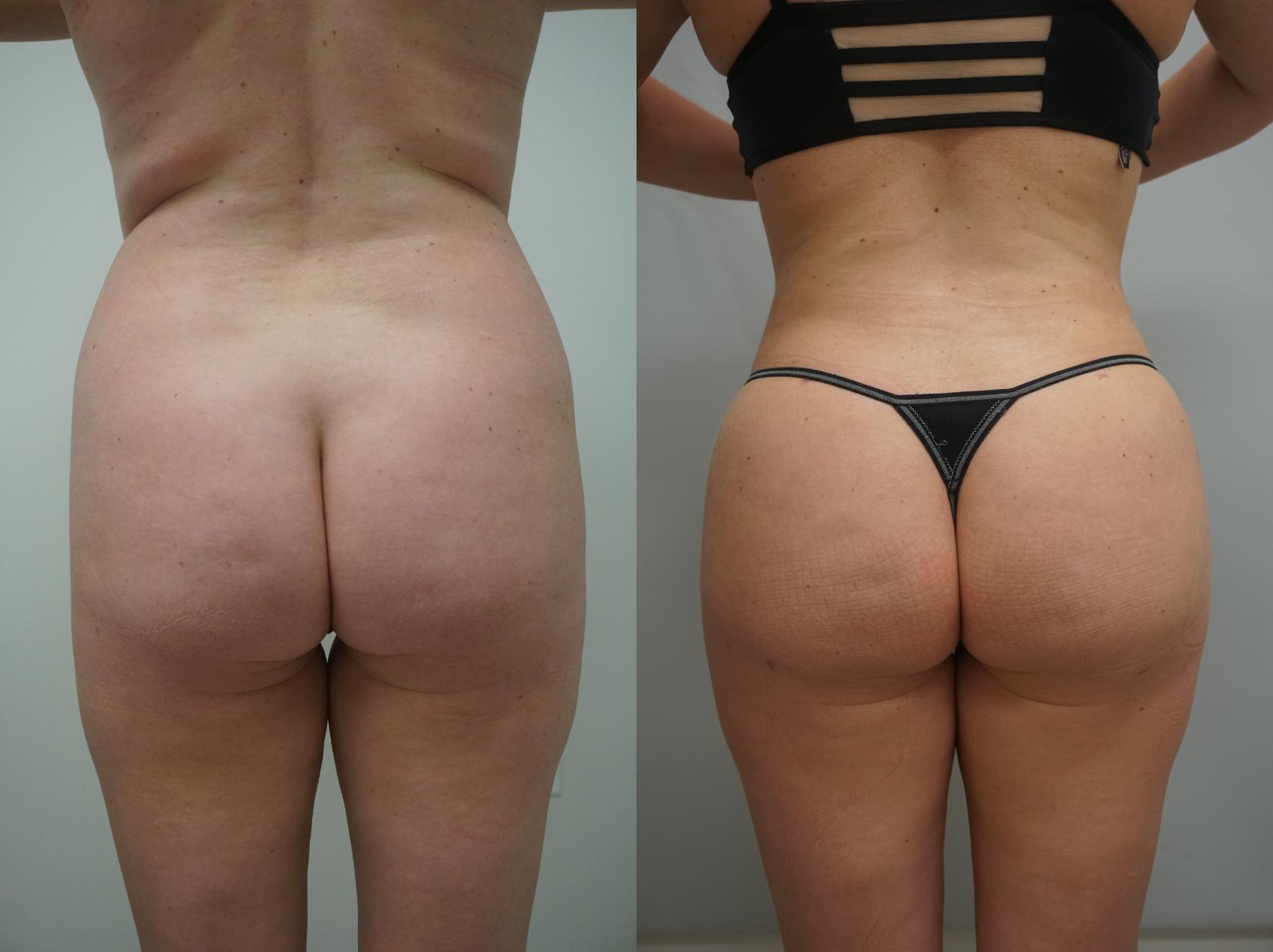 Before & After Brazilian Buttock Lift Case 170 View #1 View in Gilbert, AZ