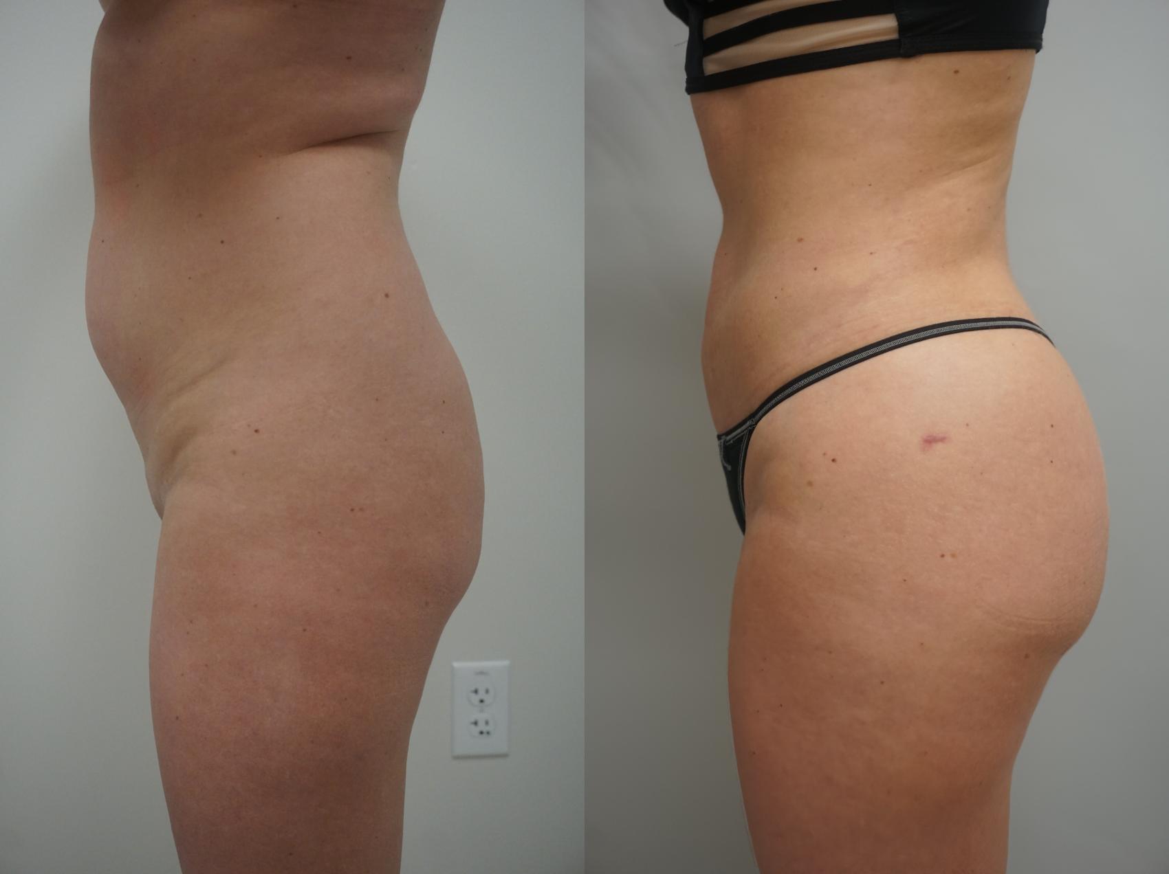 Before & After Brazilian Buttock Lift Case 170 View #2 View in Gilbert, AZ