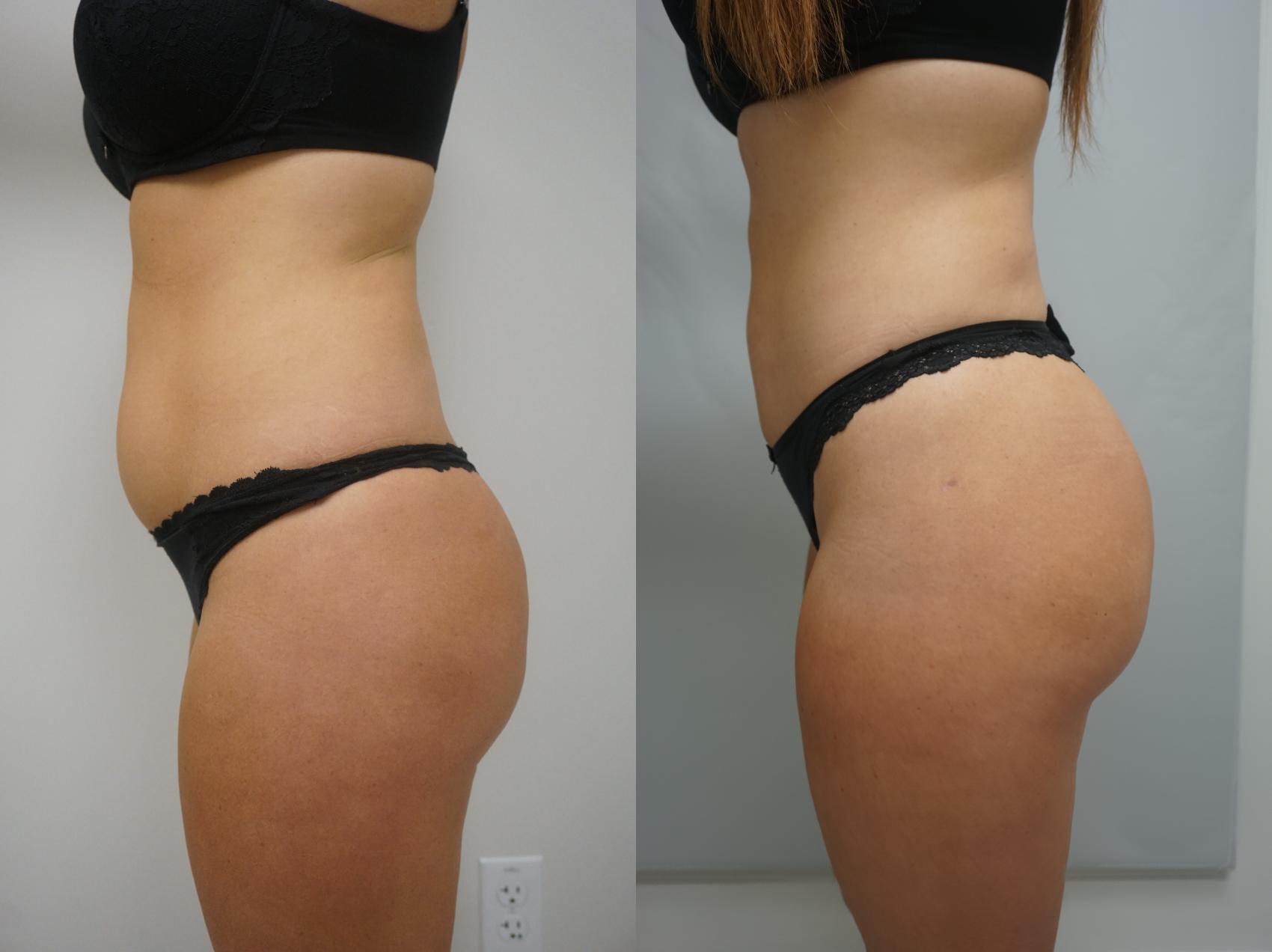 Before & After Brazilian Buttock Lift Case 197 View #2 View in Gilbert, AZ