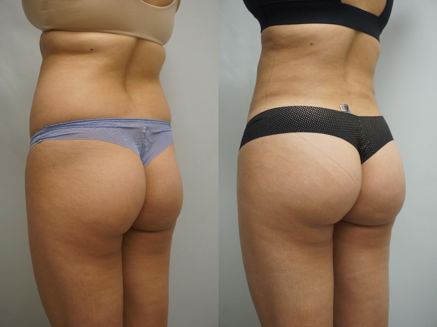 Brazilian Butt Lift Before and After Pictures Case 596