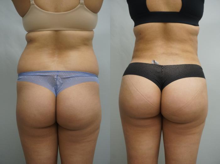 Before & After Brazilian Buttock Lift Case 250 View #2 View in Gilbert, AZ