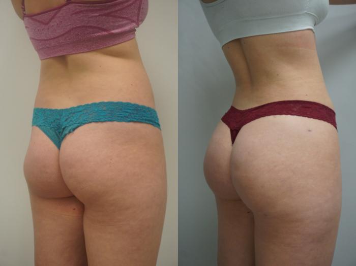 Before & After Brazilian Buttock Lift Case 262 View #1 View in Gilbert, AZ