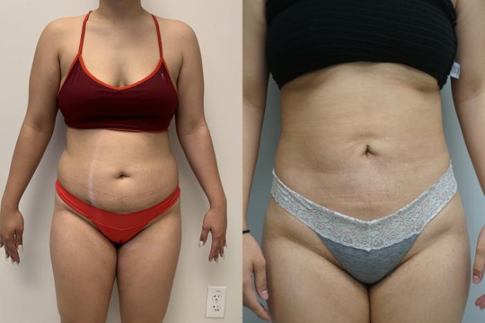 Before & After Liposuction Case 292 Front View in Gilbert, AZ