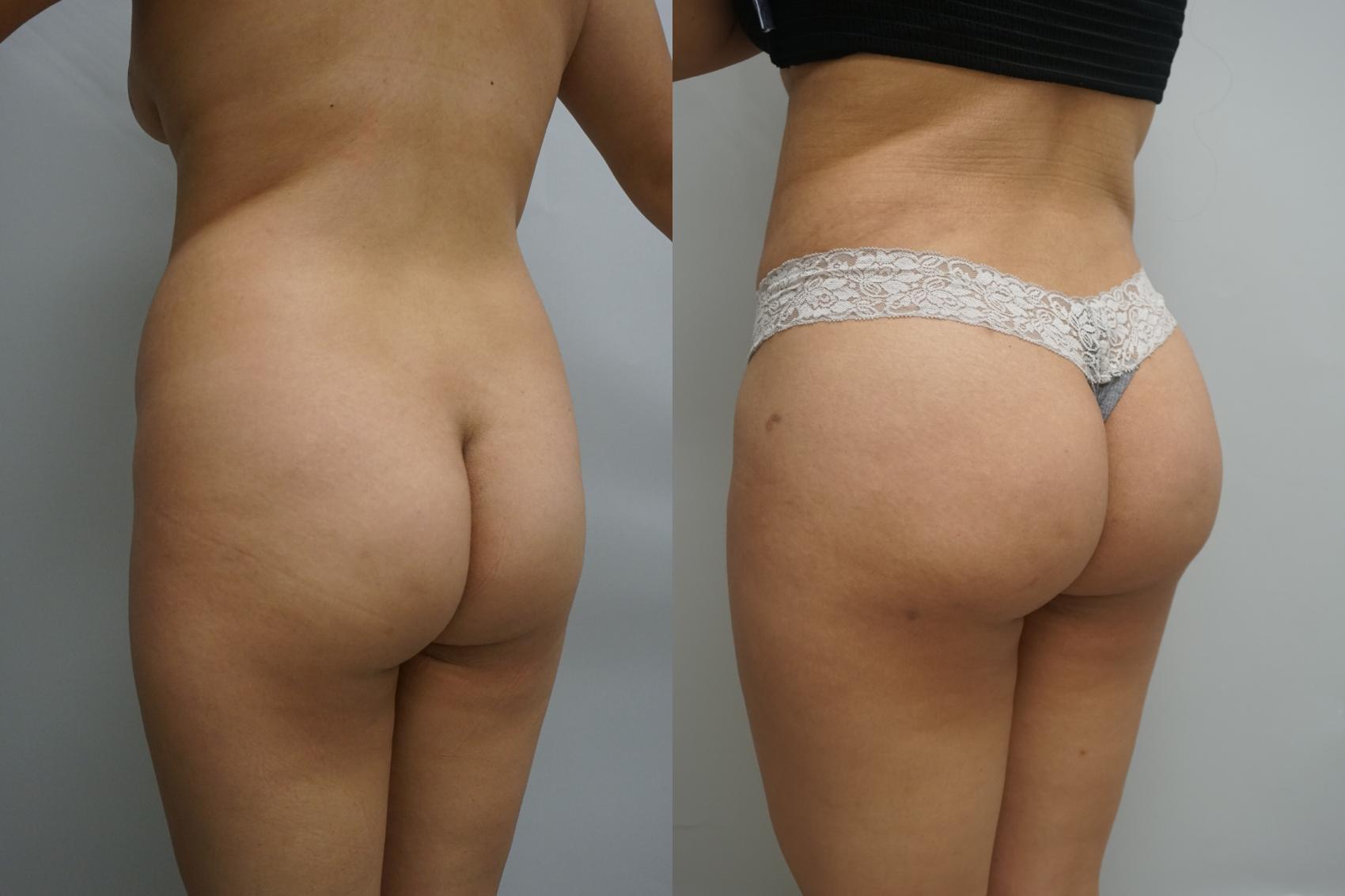 Before & After Liposuction Case 292 Left Side View in Gilbert, AZ