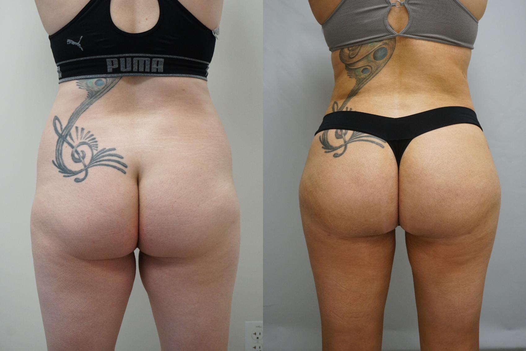 Before & After Brazilian Buttock Lift Case 294 Back View in Gilbert, AZ