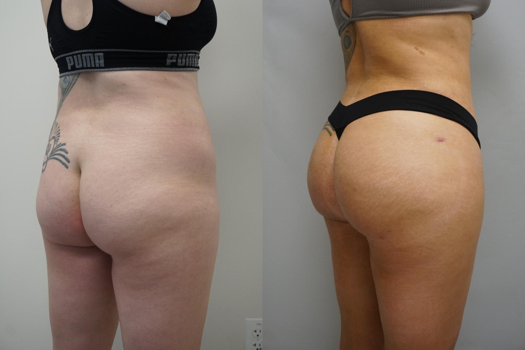 Before & After Brazilian Buttock Lift Case 294 Right Side View in Gilbert, AZ