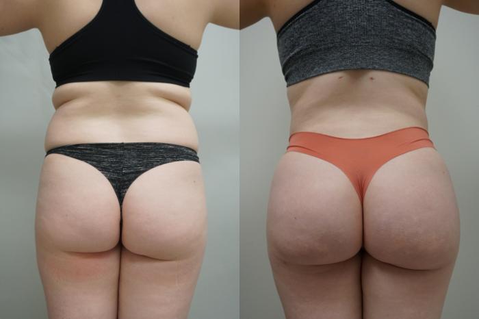Before & After Liposuction Case 296 Back View in Gilbert, AZ