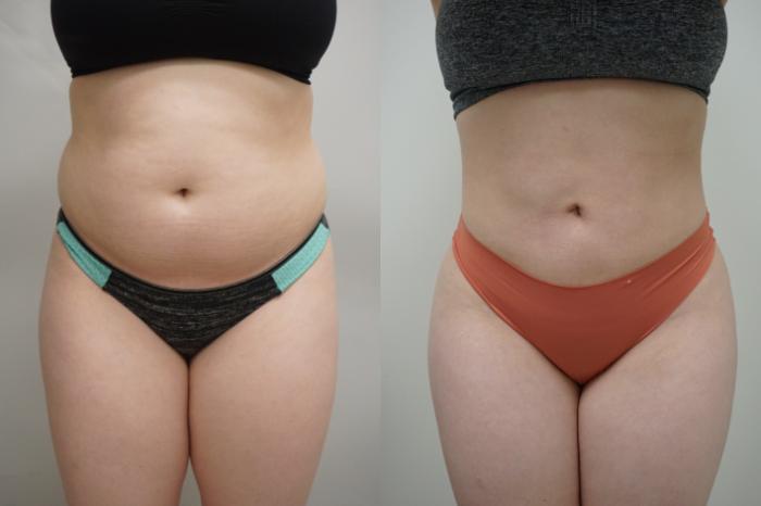 Before & After Liposuction Case 296 Front View in Gilbert, AZ