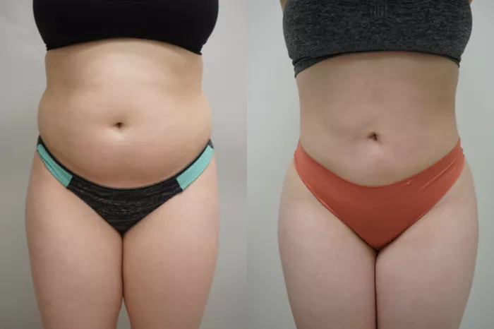 Brazilian Buttock Lift Before and After Pictures Case 296