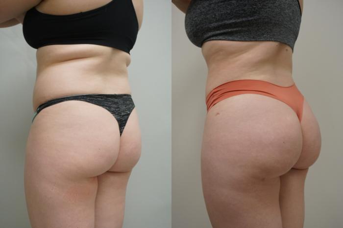 Before & After Liposuction Case 296 Left Oblique View in Gilbert, AZ
