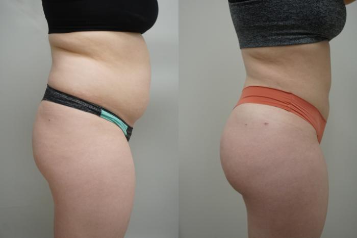 Before & After Brazilian Buttock Lift Case 296 Right Side View in Gilbert, AZ