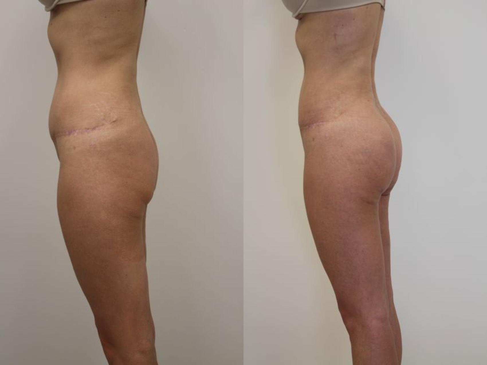 Before & After Brazilian Buttock Lift Case 30 View #1 View in Gilbert, AZ
