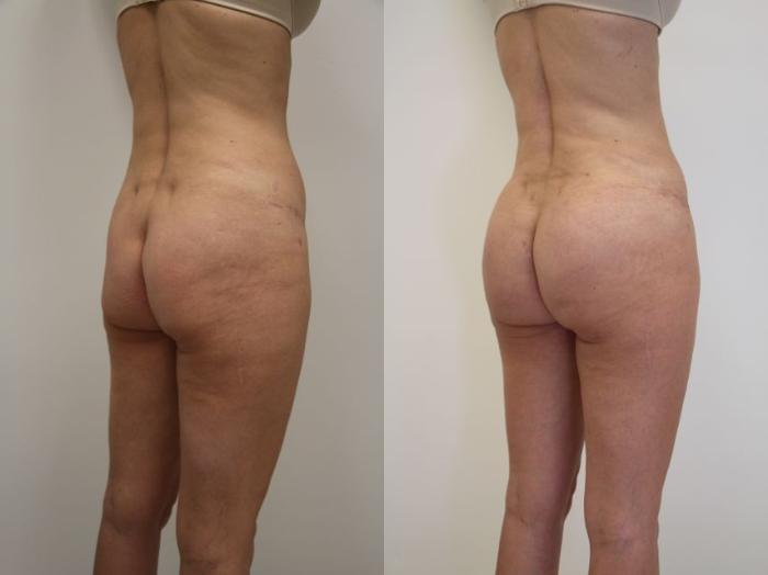 Before & After Brazilian Buttock Lift Case 30 View #2 View in Gilbert, AZ