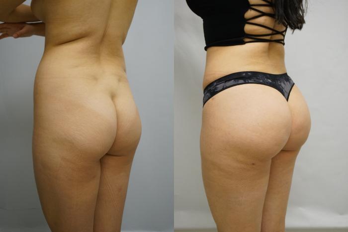 Before & After Brazilian Buttock Lift Case 425 Left Oblique View in Gilbert, AZ