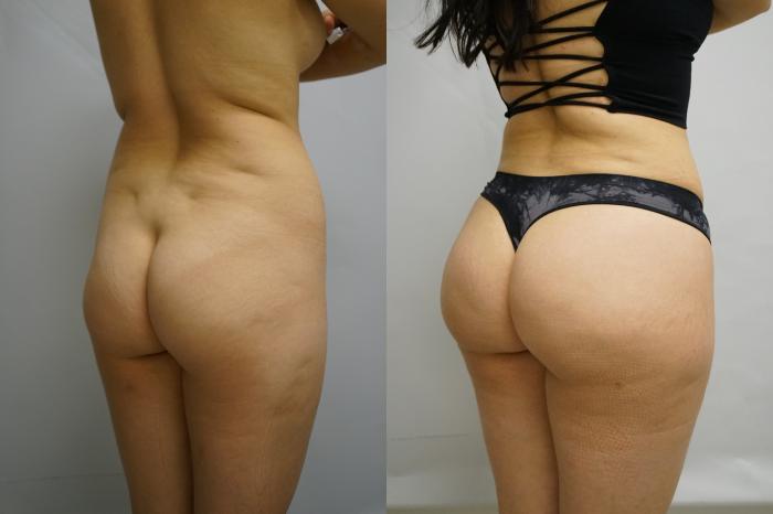 Before & After Brazilian Buttock Lift Case 425 Right Oblique View in Gilbert, AZ