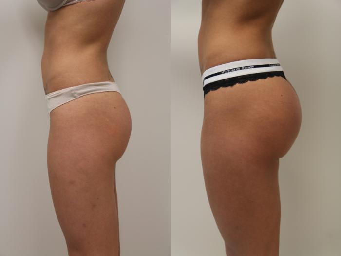 Before & After Buttock Augmentation Gallery - Cosmetic Surgery