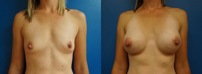 Before & After Breast Augmentation Case 1 View #1 View in Gilbert, AZ