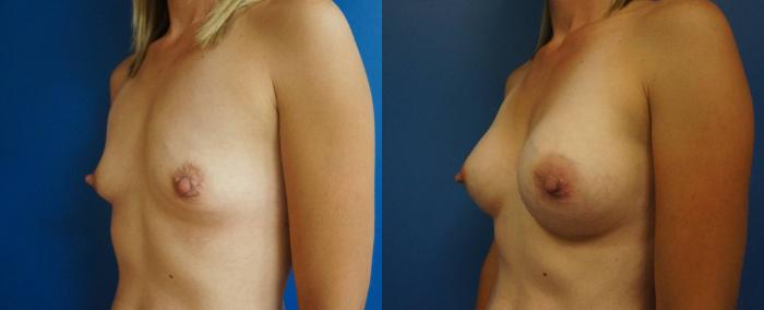 Before & After Breast Augmentation Case 1 View #2 View in Gilbert, AZ