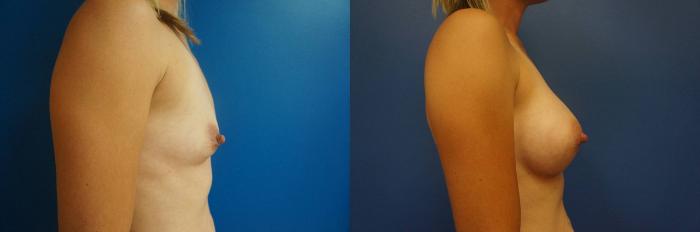 Before & After Breast Augmentation Case 1 View #3 View in Gilbert, AZ