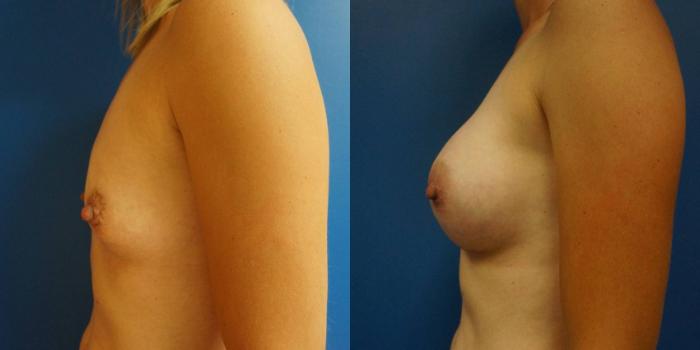 Before & After Breast Augmentation Case 1 View #4 View in Gilbert, AZ