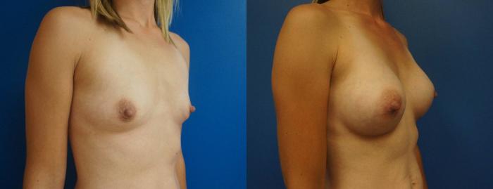 Before & After Breast Augmentation Case 1 View #5 View in Gilbert, AZ