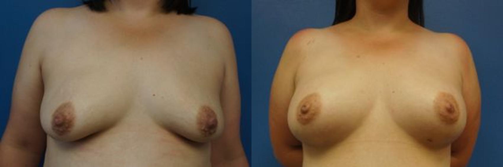 Before & After Breast Augmentation Case 10 View #1 View in Gilbert, AZ