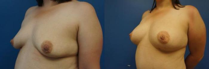 Before & After Breast Augmentation Case 10 View #2 View in Gilbert, AZ