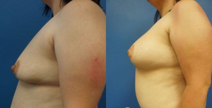 Before & After Breast Augmentation Case 10 View #3 View in Gilbert, AZ