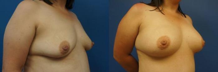Before & After Breast Augmentation Case 10 View #4 View in Gilbert, AZ