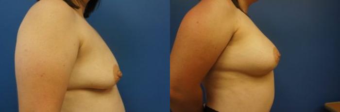 Before & After Breast Augmentation Case 10 View #5 View in Gilbert, AZ