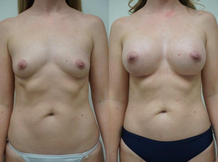 Before & After Breast Augmentation Case 103 View #1 View in Gilbert, AZ