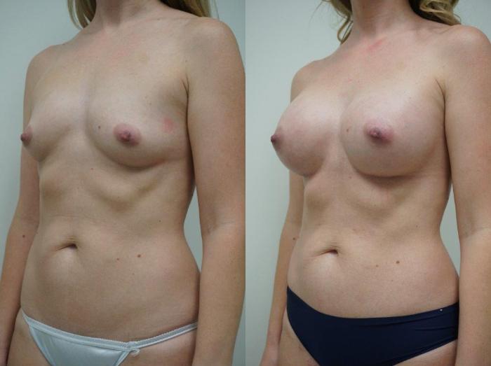 Before & After Breast Augmentation Case 103 View #2 View in Gilbert, AZ