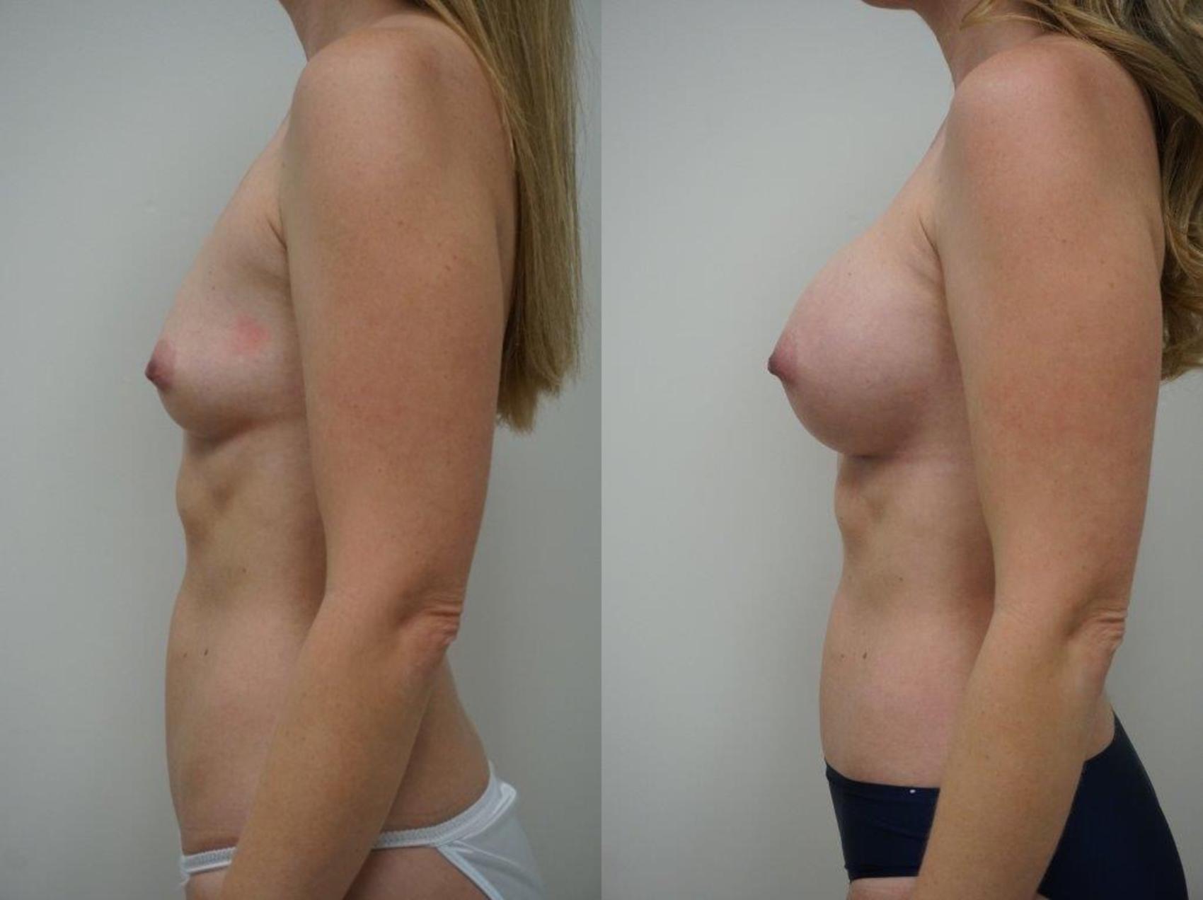 Before & After Breast Augmentation Case 103 View #3 View in Gilbert, AZ