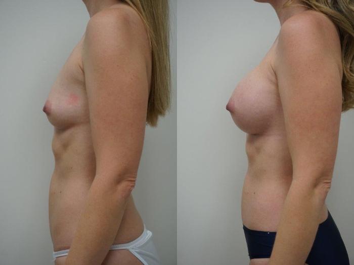 Before & After Breast Augmentation Case 103 View #3 View in Gilbert, AZ