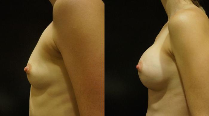 Before & After Breast Augmentation Case 11 View #2 View in Gilbert, AZ