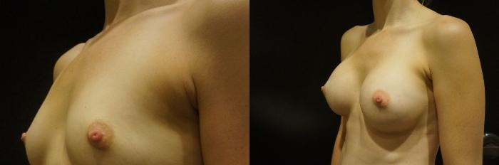 Before & After Breast Augmentation Case 11 View #3 View in Gilbert, AZ
