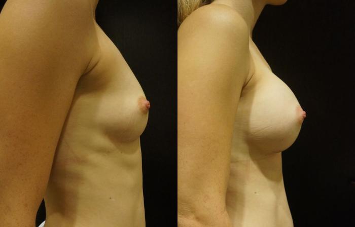 Before & After Breast Augmentation Case 11 View #4 View in Gilbert, AZ