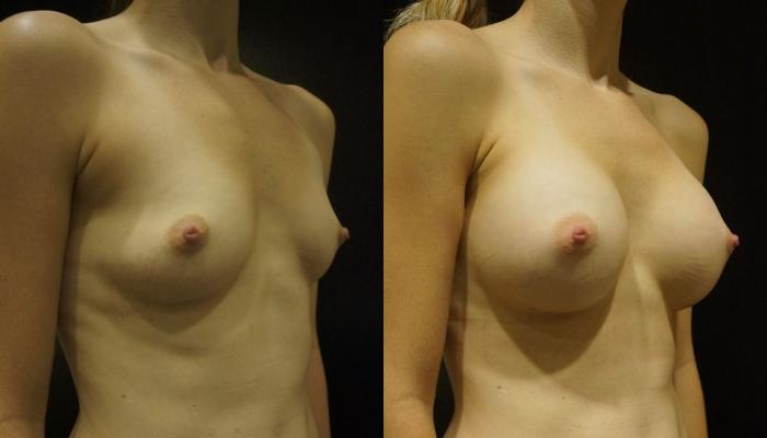 Before & After Breast Augmentation Case 11 View #5 View in Gilbert, AZ