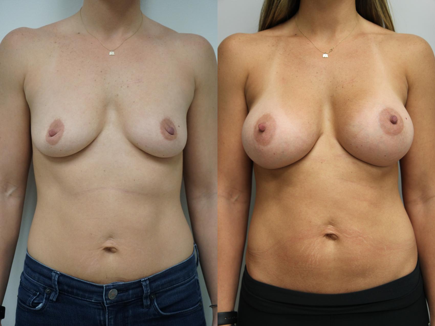 Before & After Breast Augmentation Case 116 View #1 View in Gilbert, AZ
